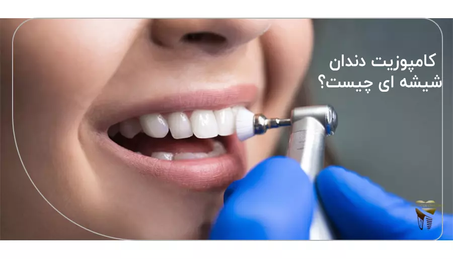 کامپوزیت دندان شیشه ای