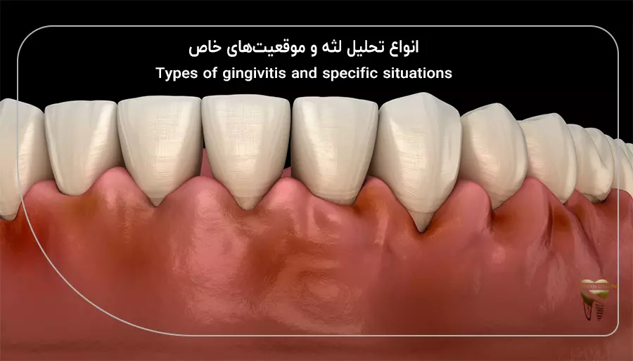 انواع تحلیل لثه و موقعیت‌های خاص