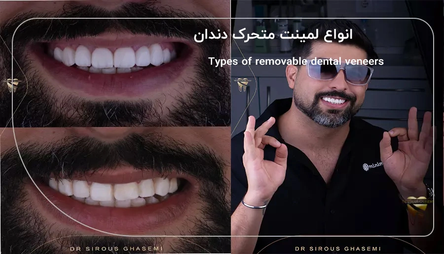 انواع لمینت متحرک دندان