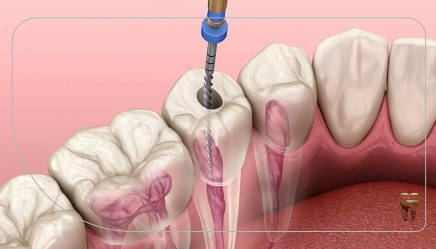عصب‌کِشی یا عصب‌کُشی؛ کدام درست است؟