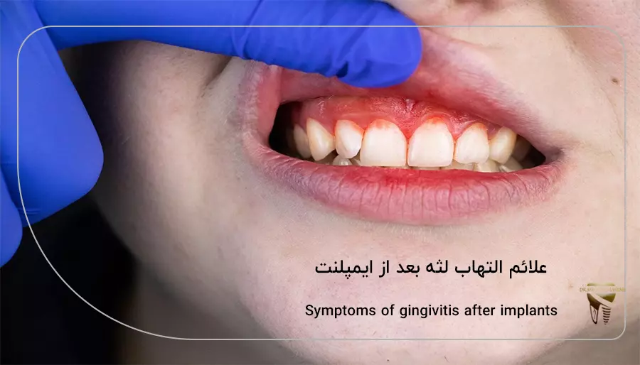 علائم التهاب لثه بعد از ایمپلنت