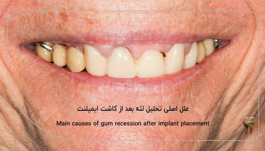 علل اصلی تحلیل لثه بعد از کاشت ایمپلنت