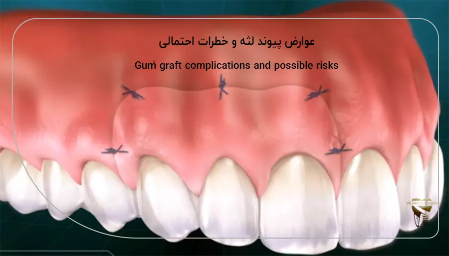 عوارض پیوند لثه و خطرات احتمالی