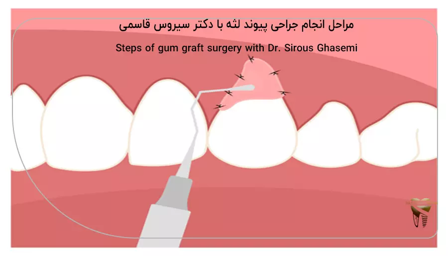 مراحل انجام جراحی پیوند لثه با دکتر سیروس قاسمی