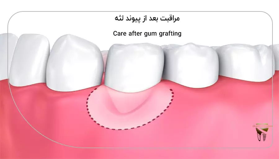 مراقبت بعد از پیوند لثه 